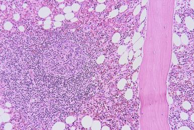 Figure 56-3, Benign lymphoid aggregate containing a reactive lymphoid follicle.