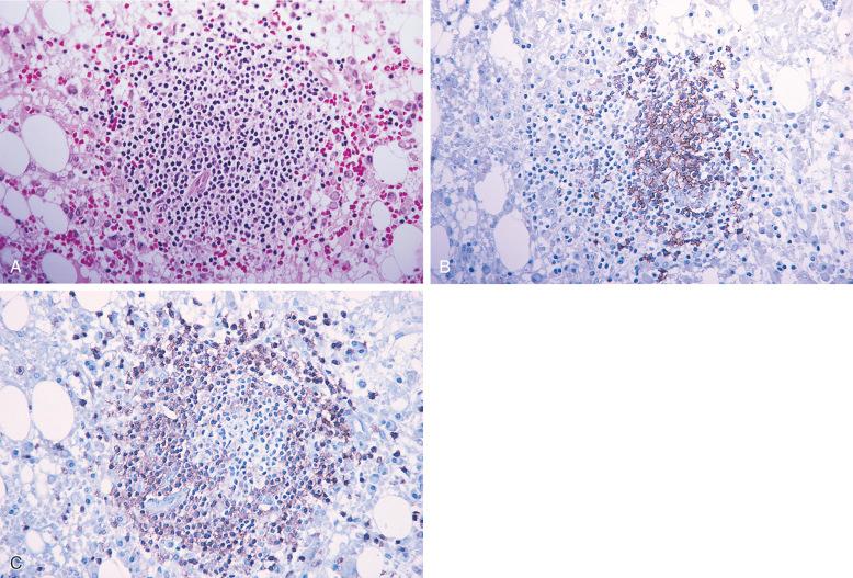 Figure 56-4, Benign lymphoid aggregate in a bone marrow core biopsy 15 days after induction chemotherapy.