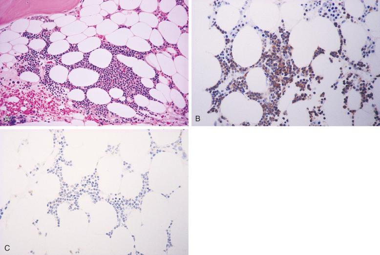 Figure 56-5, Chronic lymphocytic leukemia/small lymphocytic lymphoma (CLL/SLL) diagnosed in a bone marrow biopsy.