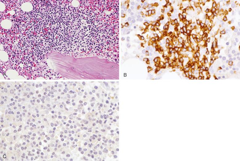 Figure 56-6, A Lymphoid aggregate in bone marrow after rituximab therapy.