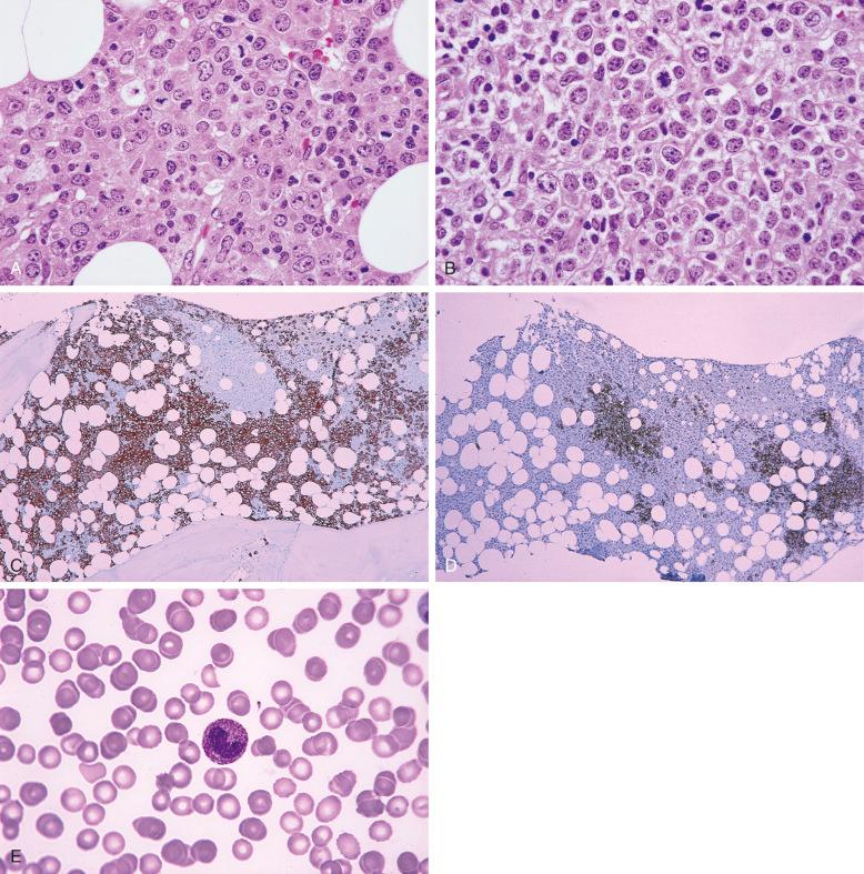 Figure 56-7, Bone marrow with residual large B-cell lymphoma and increased numbers of myelocytes and promyelocytes secondary to colony-stimulating factor therapy.