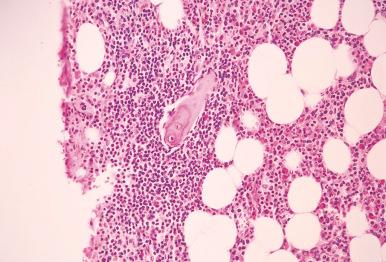 Figure 56-8, Mantle cell lymphoma identified in the deeper section of bone marrow core biopsy from a patient with an established diagnosis of mantle cell lymphoma.