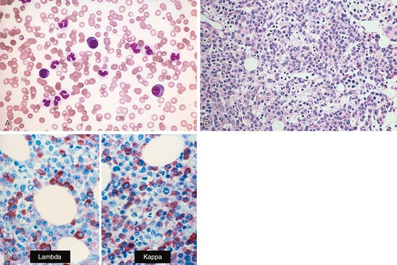 Figure 56-9, Systemic polyclonal immunoblastic proliferation.