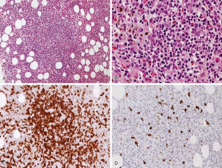 Figure 56-10, Reactive polymorphous lymphohistiocytic infiltrate in the bone marrow.