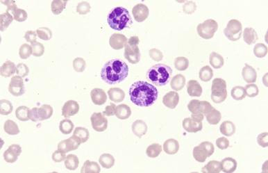 Figure 12-1, Toxic granulation and vacuolization in peripheral blood neutrophils due to infection.