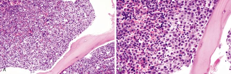 Figure 12-2, Peritrabecular myeloid precursors in bone marrow biopsy at low power (A) and high power (B), resembling metastatic carcinoma.