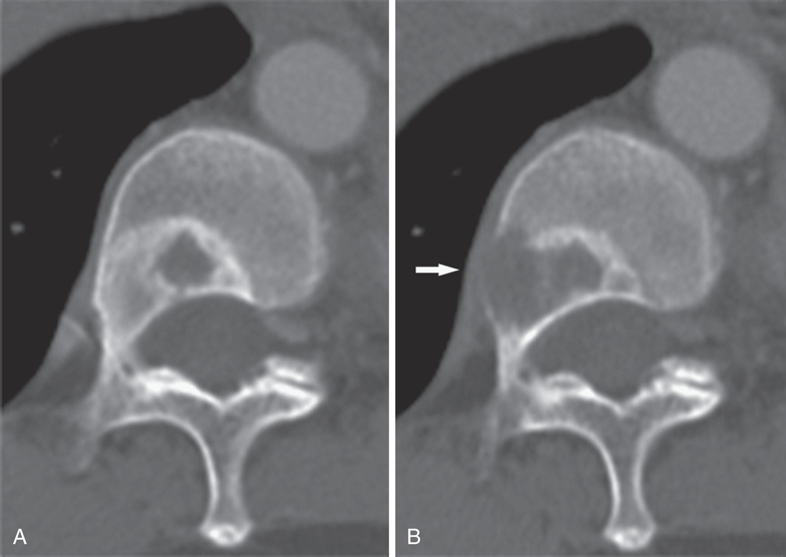 Figure 34.2, Appearance of bone metastases. A , Computed tomography of a well-defined mixed lytic/blastic bone metastases from non–small-cell lung cancer. B , Eight months later, lytic disease has progressed. The new area of osteolysis is ill-defined and expansile and demonstrates a permeative margin that destroys the cortex of the vertebral body ( arrow ).