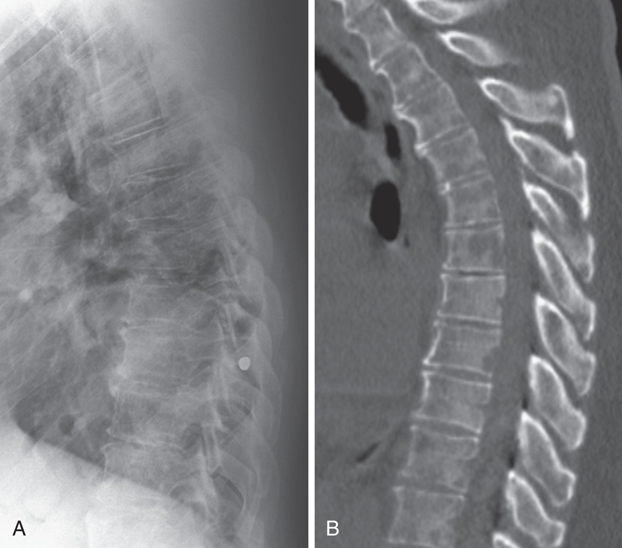 Figure 34.3, Effect of overlapping structures in a patient with multiple myeloma. A , Lateral radiograph of the thoracic spine demonstrates generalized osteopenia but no discrete lesions. B , Sagittal computed tomography reformation reveals numerous lytic, myelomatous lesions that were obscured by overlapping ribs and lung parenchyma on the radiograph.