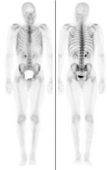 Figure 78-1, Normal 99m Tc-MDP distribution on whole-body bone scan in anterior (left) and posterior (right) projections. Note uniform radiotracer uptake throughout bones with some uptake in kidneys and bladder.