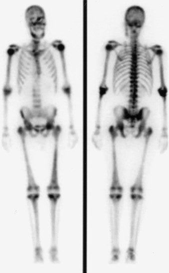 Figure 78-2, “Superscan” on whole-body 99m Tc-MDP bone scan (anterior and posterior projections). Note intense radiotracer uptake throughout almost all bones with no significant radiotracer excretion seen in kidneys or bladder. Some areas, such as proximal humeri and left femur, have particularly intense radiotracer uptake. This patient had widespread metastatic prostate cancer.