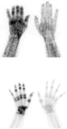 Figure 78-3, RSD on triple-phase 99m Tc-MDP bone scan. Note diffusely increased radiotracer uptake throughout entire right forearm and hand ( left column ) on blood pool images ( top row ) and periarticular radiotracer uptake on delayed bone scan images ( bottom row ) relative to contralateral side.