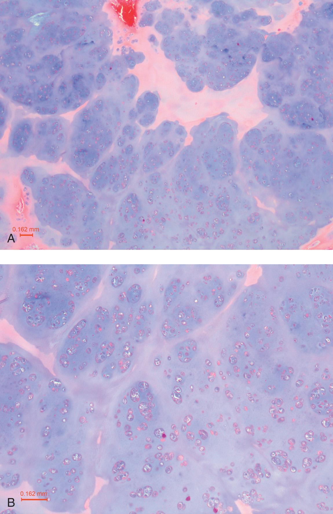 Figure 16.19, A , The nodular growth of this laryngeal chondrosarcoma is readily appreciated on low-power view (25×; H&E). B , At slightly higher magnification (50×; H&E), multiple abnormal chondrocytes crowded within lacunar spaces are seen.