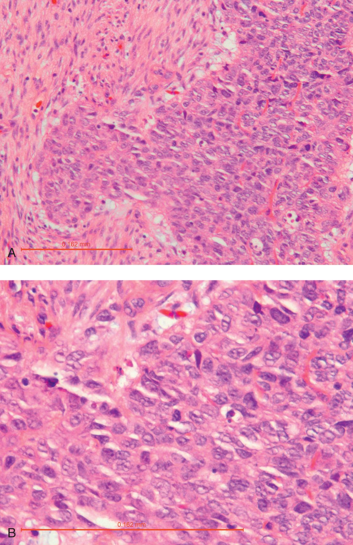 Figure 16.24, Sinonasal Ewing sarcoma demonstrates marked nuclear pleomorphism and an epithelioid appearance with 200× ( A ) and 400× ( B ); H&E.