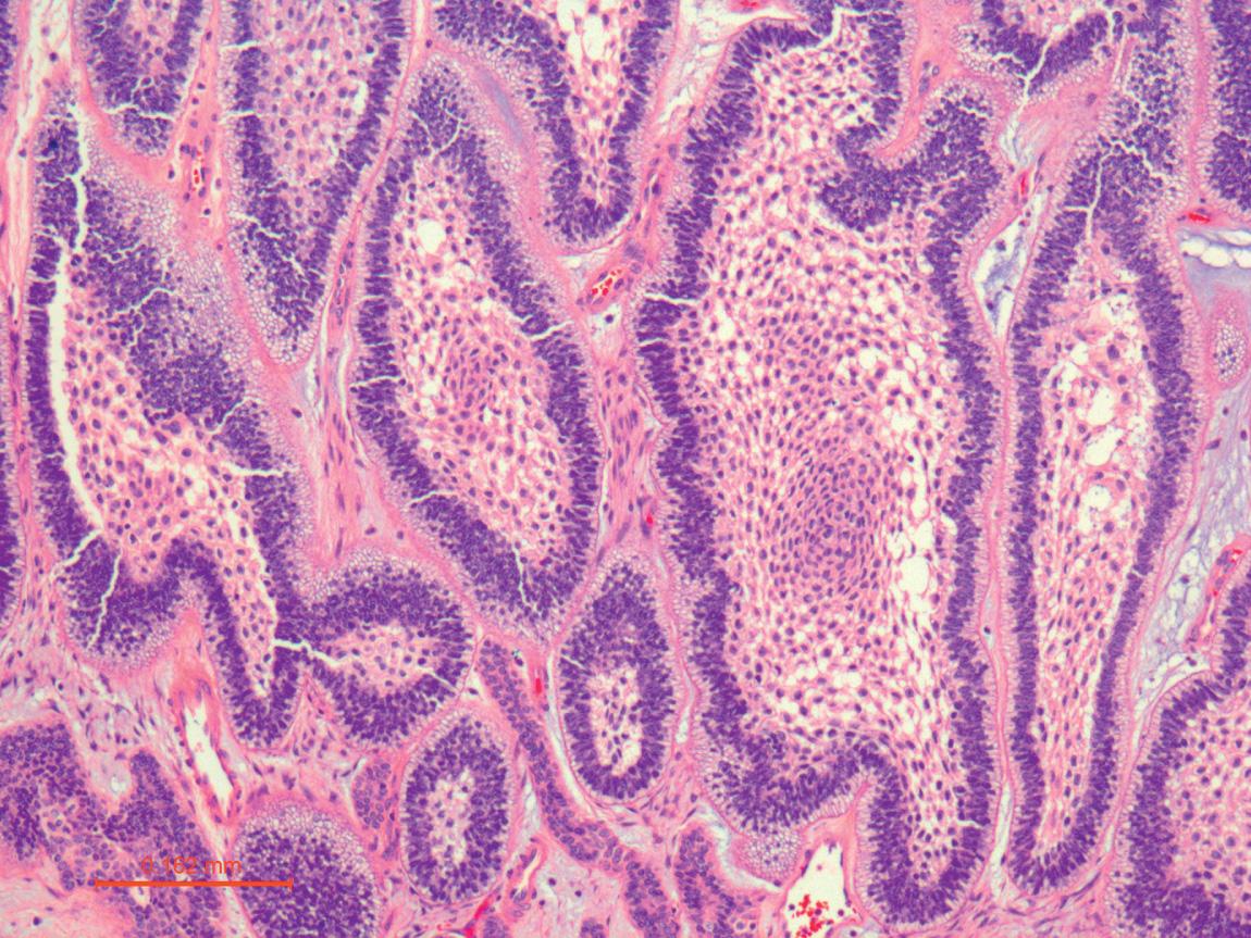 Figure 16.26, Ameloblastoma of the maxilla (100×; H&E) showing subnuclear vacuoles, giving the periphery of the tumor a “picket fence–like” appearance.