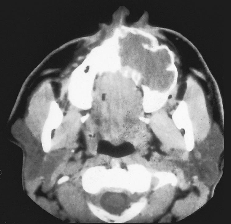 Figure 16.10, A soft-tissue window of an axial computed tomography scan through the upper alveolus demonstrating a hypodense, expansile, bone-destructive lesion.