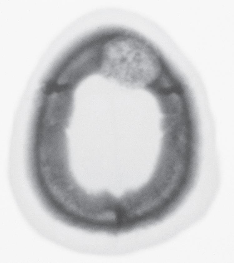 Figure 16.29, The bone window of the computed tomography scan of the same patient as in Table 16.1 shows the punched-out defect in the frontal bone.