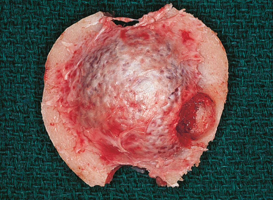 Figure 16.31, The surgical specimen.