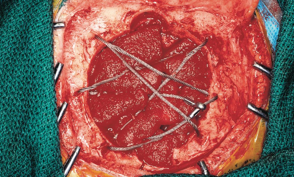 Figure 16.32, Braided wire is crisscrossed between the edges of the surgical defect.