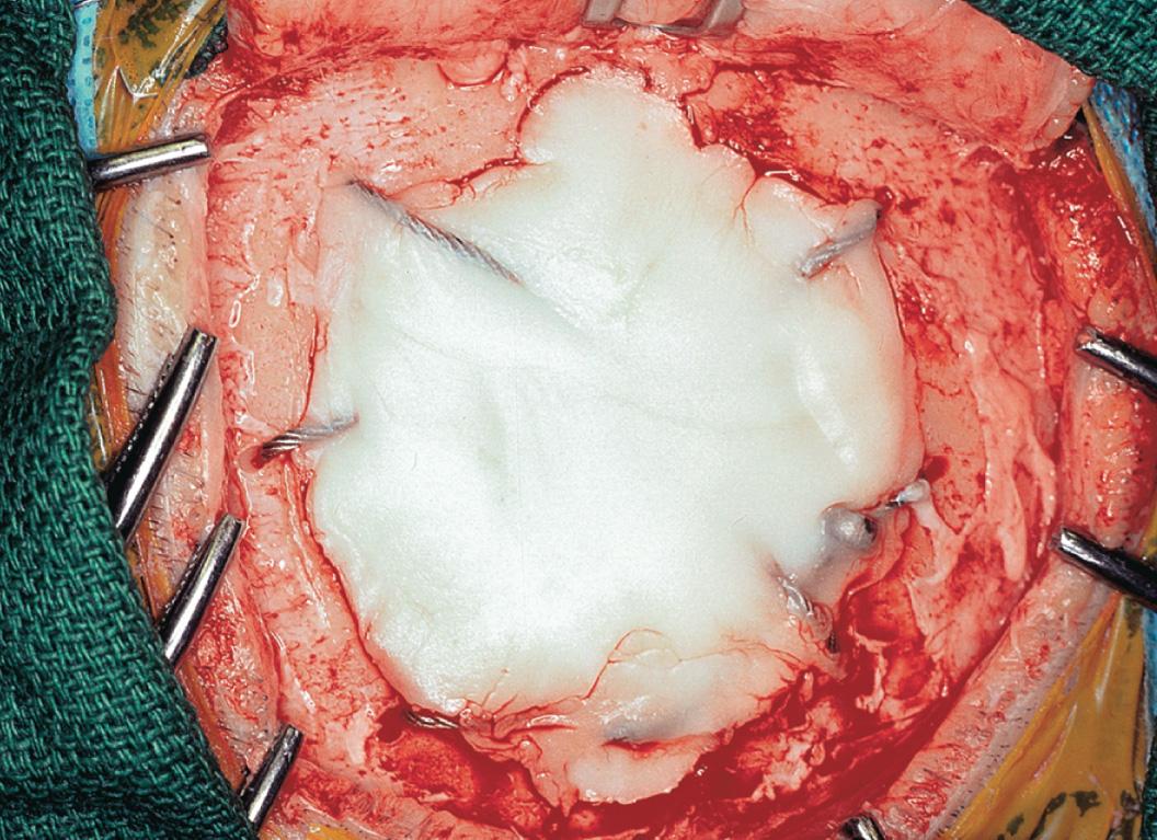 Figure 16.33, The wire acts as a matrix over which the bone cement is placed to provide a shell to repair the craniectomy defect.