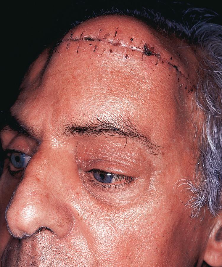 Figure 16.35, A patient with a bony lesion on the forehead. The scar of an open biopsy is visible.