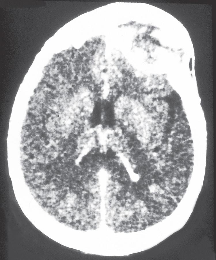 Figure 16.36, An axial computed tomography scan with a soft tissue window showing a massive tumor with intracranial and extracranial extension.