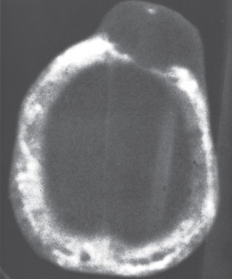 Figure 16.37, An axial CT scan of the head with a bone window showing the bone-destructive tumor and involvement of the cranium with Paget's disease.