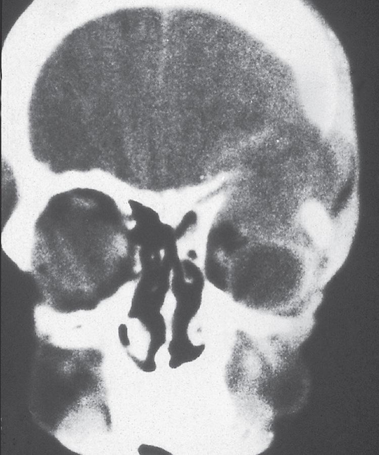 Figure 16.38, A coronal view of a computed tomography scan showing extension of the tumor into the orbit.