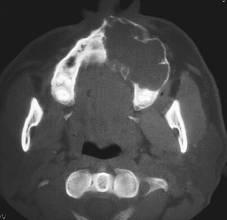 Figure 16.11, A bone window of the axial computed tomography scan of the patient shown in Fig. 16.10 demonstrating the expansile bone-destructive lesion of the upper alveolus.