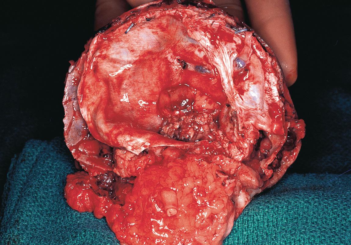 Figure 16.41, The posterior view of the specimen showing the intracranial tumor and the resected portion of the dura.