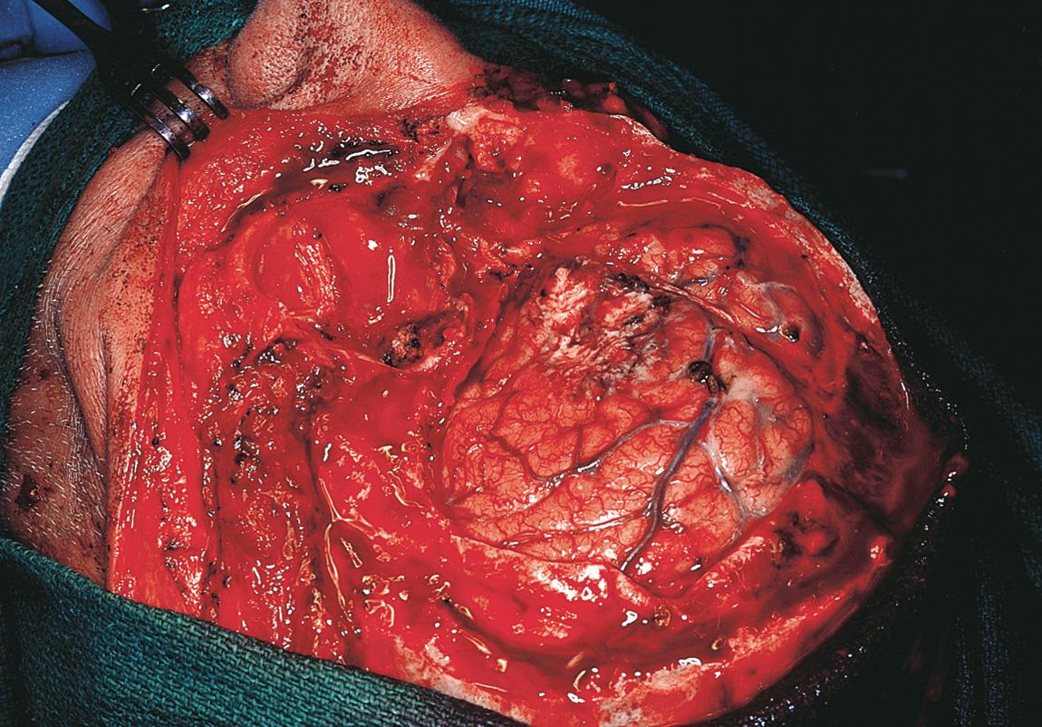 Figure 16.42, A close-up view of the surgical defect showing the exposed brain and the dural defect.