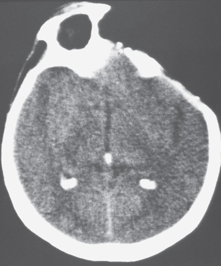 Figure 16.44, A postoperative computed tomography scan.