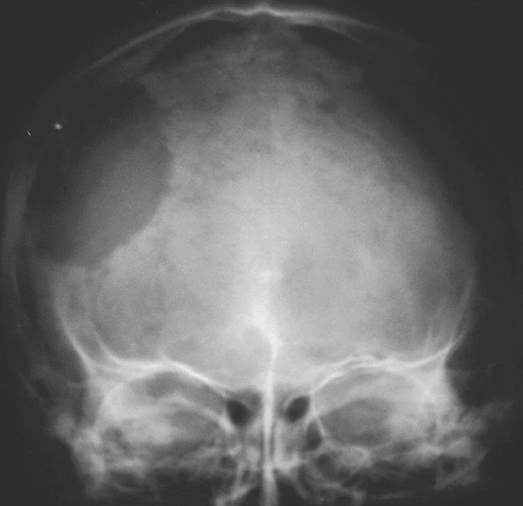 Figure 16.45, The anteroposterior view of the plain radiograph of the skull.