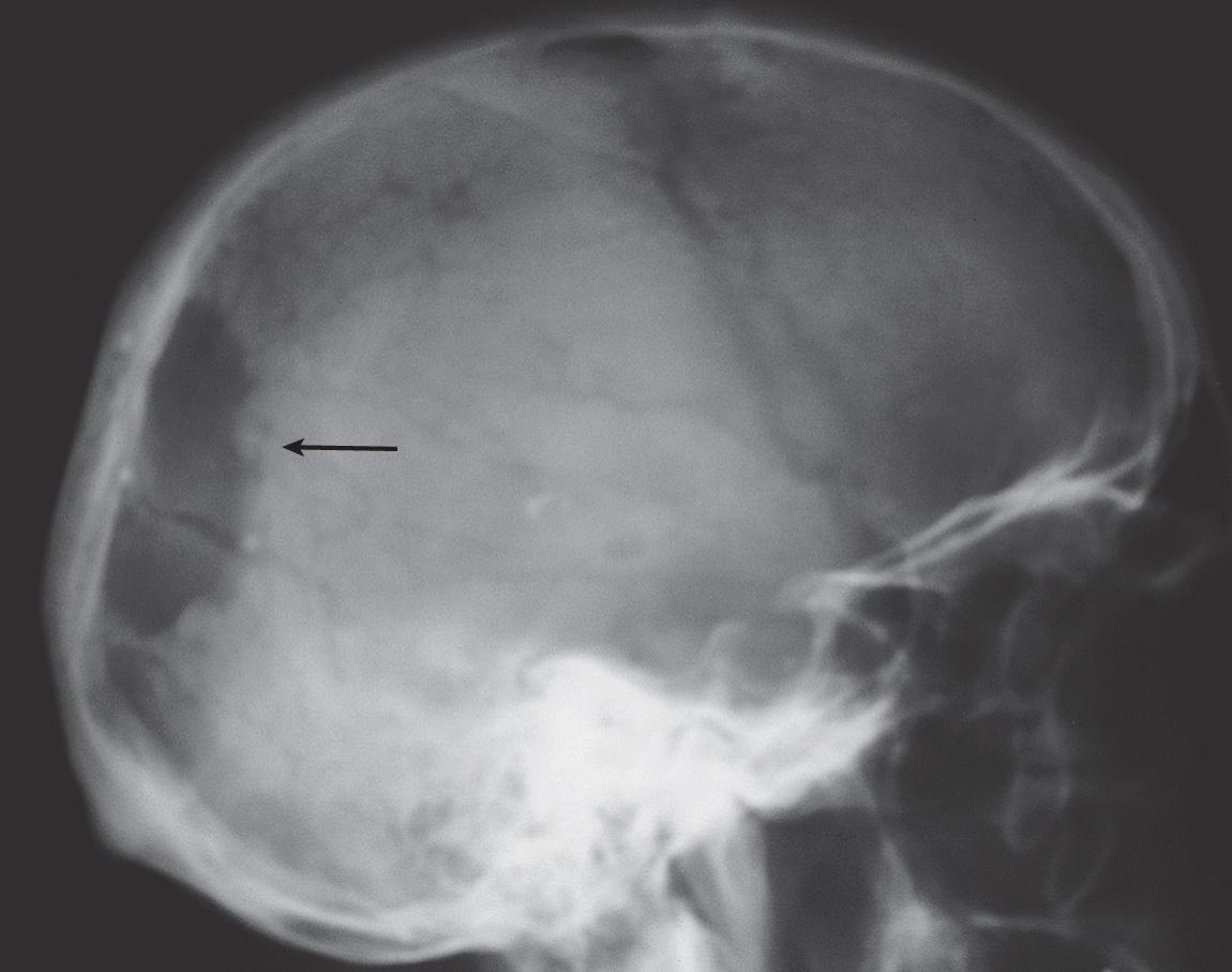 Figure 16.46, The lateral view of the plain radiograph of the skull showing the osteolytic lesion ( arrow ).