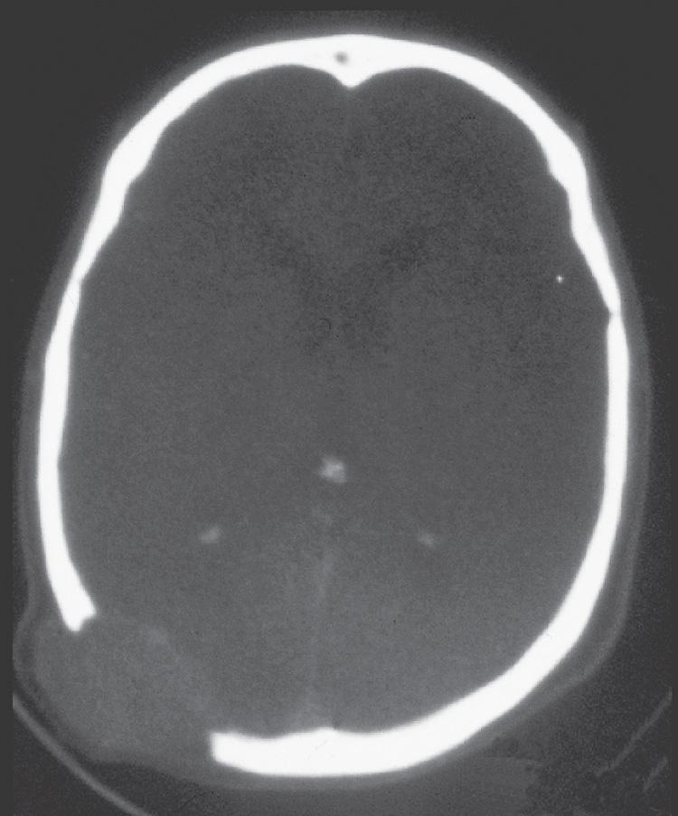 Figure 16.48, A computed tomography scan of the skull with a bone window shows a punched-out area of bone destruction.