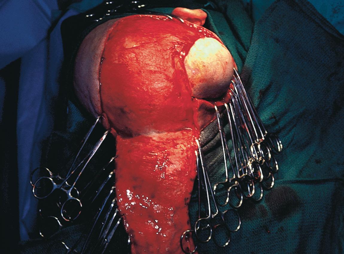 Figure 16.51, The parietal scalp flap is elevated in a subgaleal plane, remaining superficial to the pericranium.