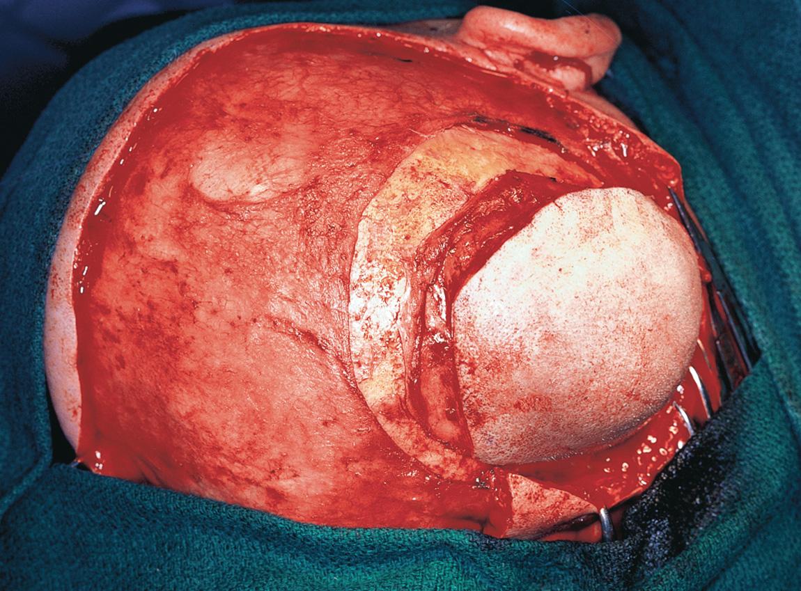 Figure 16.52, A circumferential incision is made in the periosteum around the tumor.