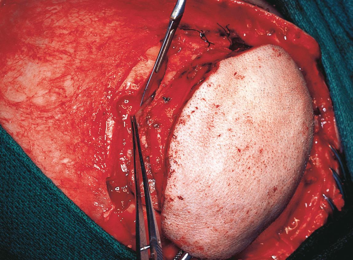 Figure 16.53, A circumferential craniectomy is completed through multiple burr holes, and the dura is opened.