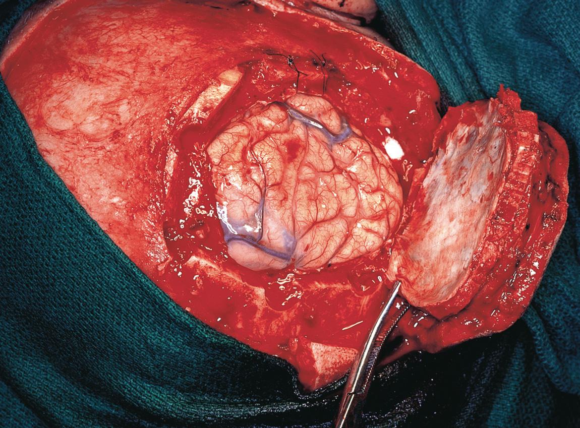 Figure 16.54, The surgical specimen is reflected posteriorly with the dura as its deep margin.