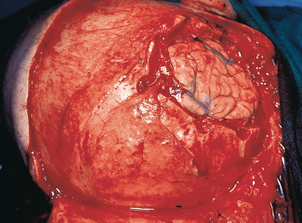 Figure 16.56, The periosteum covering the skull in the occipital region is exposed, and a pericranial graft is harvested.