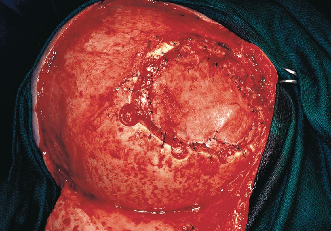 Figure 16.57, This periosteal graft is sutured to the edges of the dura.