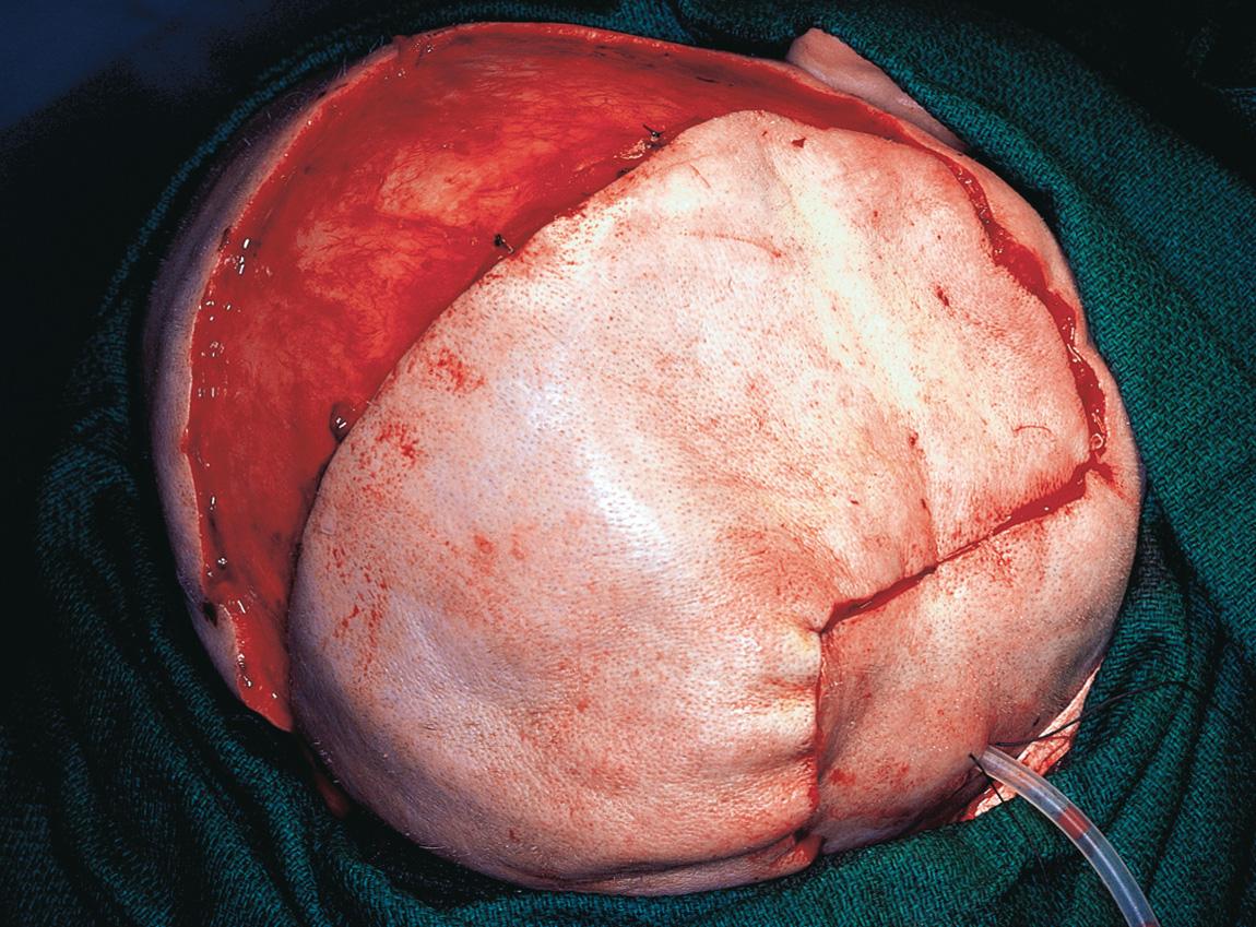 Figure 16.59, The donor site defect has its periosteum intact, over which a split-thickness skin graft is applied.