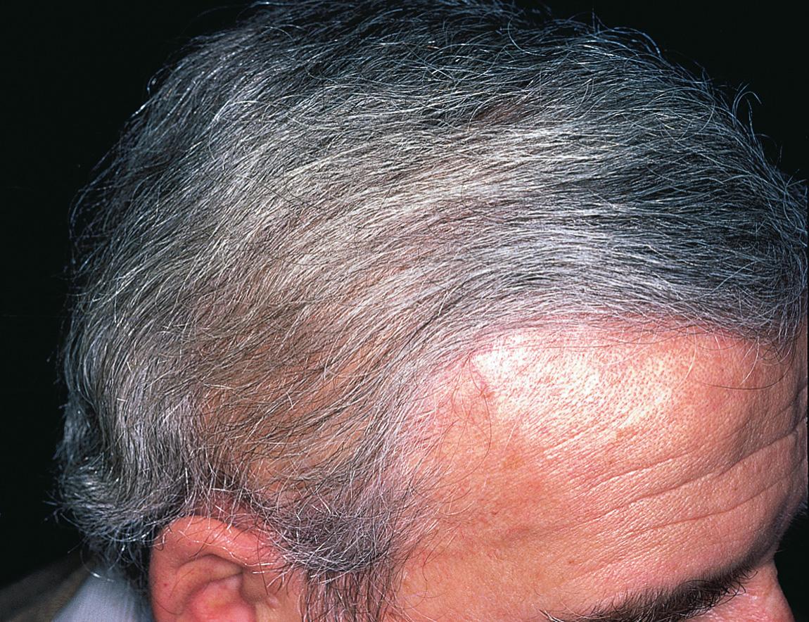 Figure 16.62, The appearance of the patient 9 months after surgery.