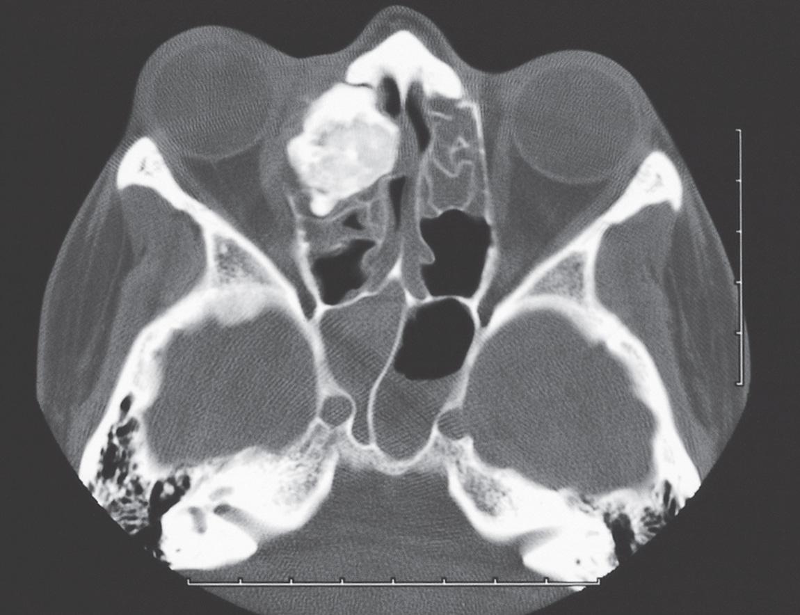 Figure 16.63, An axial view of the computed tomography scan (bone window) shows a dense lesion of the right ethmoid sinus pushing the globe anteriorly.