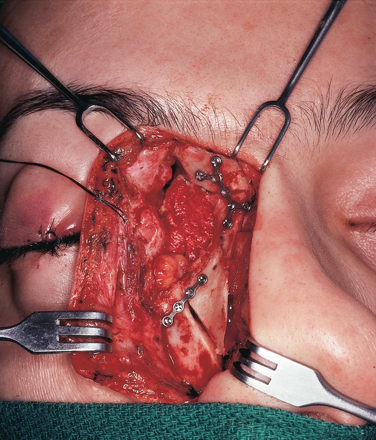 Figure 16.67, The facial bones are repositioned with the use of microplates and screws.