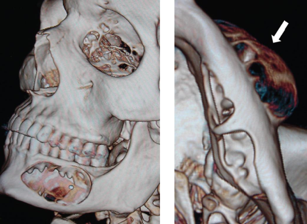 Figure 16.14, The lateral and inferior views of the three-dimensional reconstruction of the computed tomography scan of the patient shown in Figs. 16.9 through 16.11 showing the expansile lesion ( arrow ).