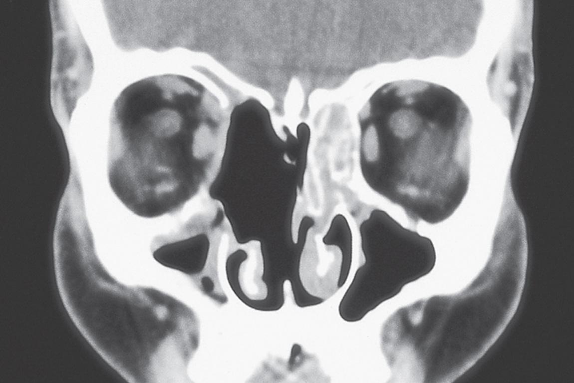 Figure 16.69, A coronal view of the postoperative computed tomography scan shows complete excision of the tumor.