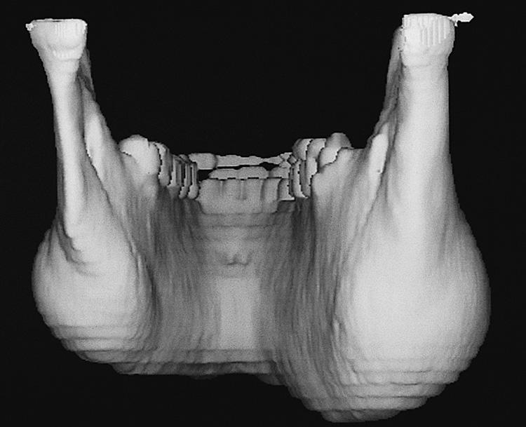 Figure 16.16, The posterior view of the three-dimensional computed tomography reconstruction demonstrates the full-thickness involvement of the mandible.