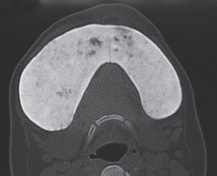 Figure 16.17, An axial view of the computed tomography scan (bone window) shows the featureless “ground glass” appearance of the pathologic bone.