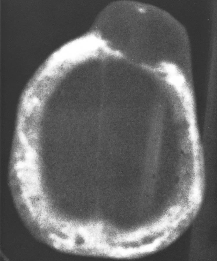 Figure 16.18, Axial view of CT scan of the skull in bone window shows the entire calvarium involved by Paget's disease, and a bone-destructive sarcoma in the frontoparietal region.