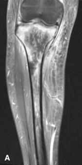 Figure 40.1, A, Coronal-plane MRI shows a diffuse infiltrate of variable signal intensity in the proximal tibia with adjacent soft tissue edema. B, In acute osteomyelitis, the inflammatory infiltrate consists primarily of neutrophils, and necrotic bone is resorbed by osteoclasts.